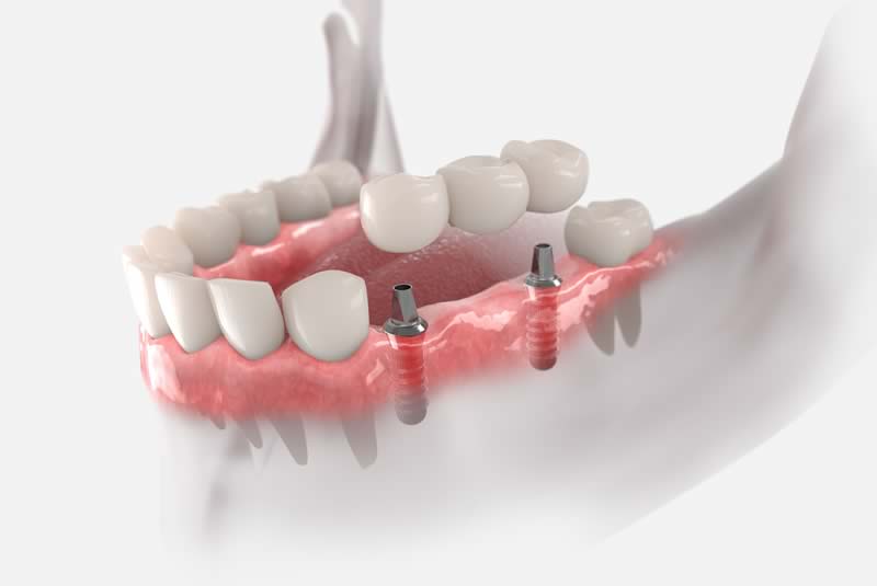 The Dental Implant and Oral Surgery Centre In Uxbridge